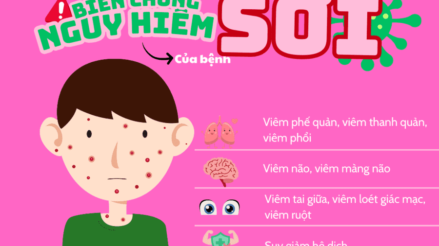 BỆNH SỞI: KẺ THÙ THẦM LẶNG CỦA SỨC KHỎE BÉ – ĐỪNG CHỦ QUAN!