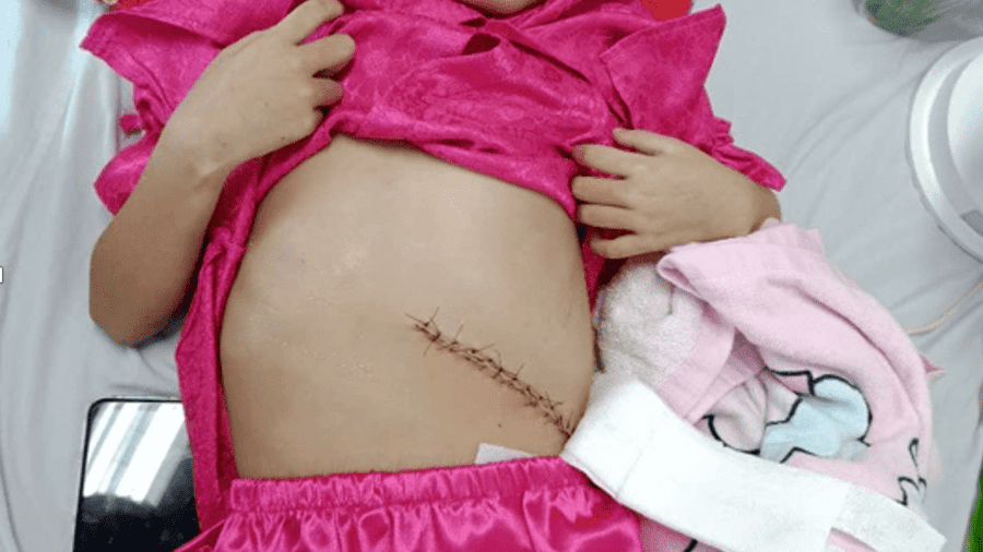🎉 PHẪU THUẬT THÀNH CÔNG CỨU SỐNG BÉ GÁI BỊ BỆNH LÝ THALASSEMIA KÈM CHẤN THƯƠNG LÁCH TẠI BỆNH VIỆN SẢN NHI KIÊN GIANG 🎉