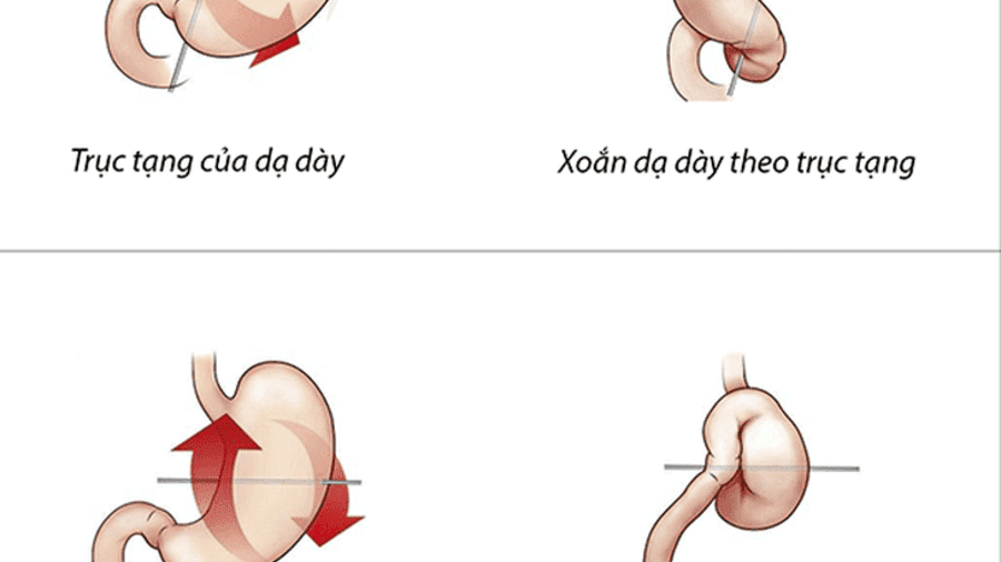 Bé trai 7 tháng tuổi mắc bệnh lý xoắn dạ dày rất hiếm gặp và nguy hiểm được các bác sĩ Bệnh viện Sản Nhi Kiên Giang phẫu thuật thành công.