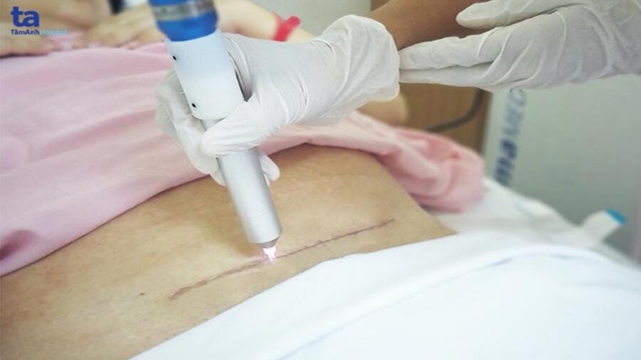 CHIẾU TIA PLASMA SAU SINH