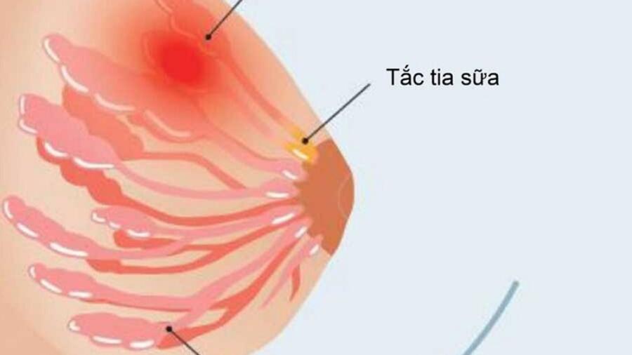 XỬ TRÍ TẮC TIA SỮA, HƯỚNG DẪN MASSAGE VÚ