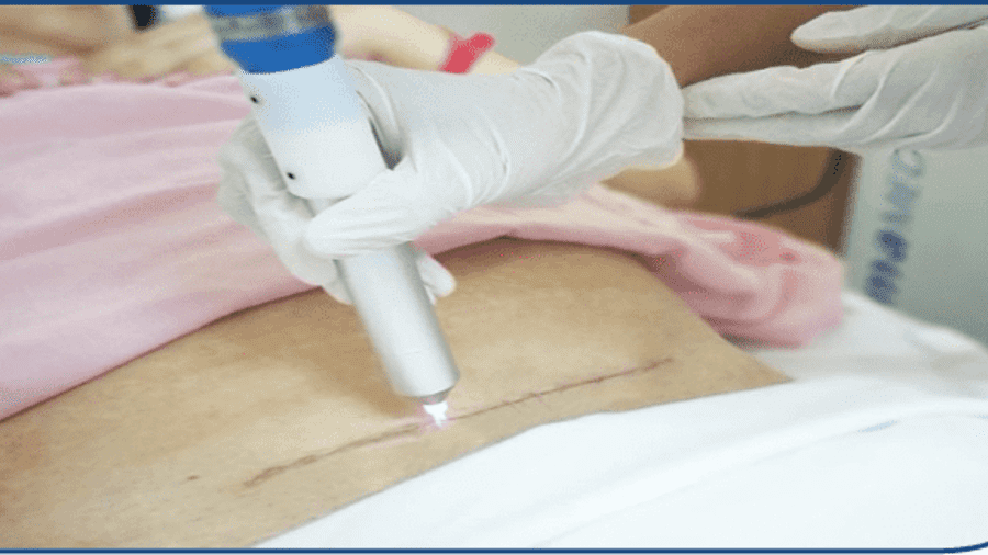 CHIẾU TIA PLASMA LẠNH CHO VẾT MỔ, VẾT KHÂU TẦNG SINH MÔN VÀ CUỐNG RỐN TRẺ SƠ SINH