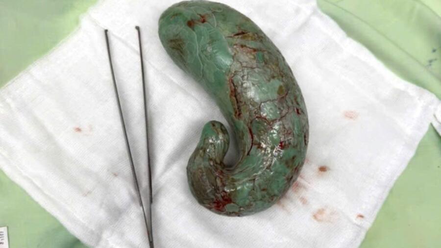 Hy hữu một bé gái 4 tuổi nuốt kẹo cao su liên tục trong nhiều tháng