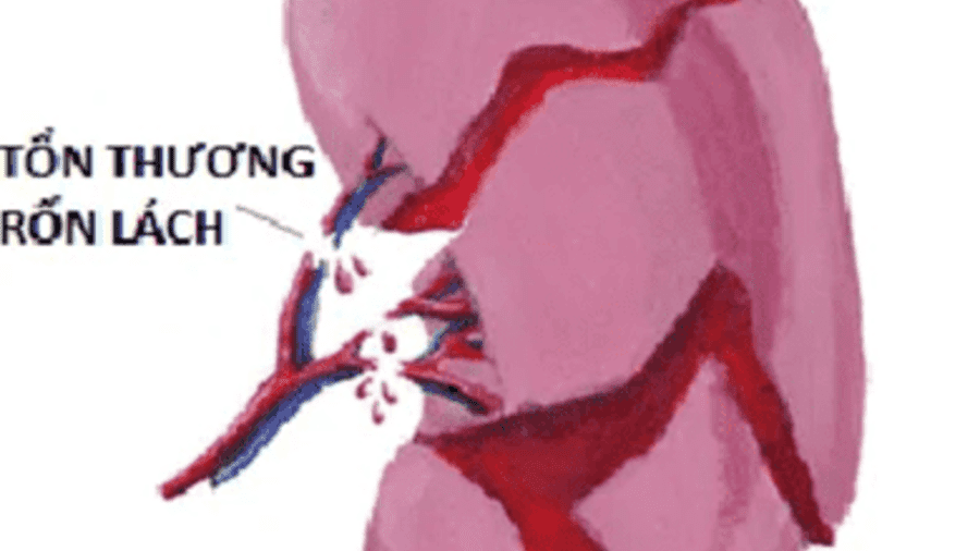 CỨU SỐNG THÀNH CÔNG BÉ TRAI 11 TUỔI SỐC MẤT MÁU VỠ LÁCH ĐỘ V DO TAI NẠN GIAO THÔNG