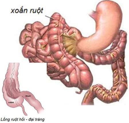 Xoắn ruột ở trẻ em: Chỉ có 6 giờ để "cứu"